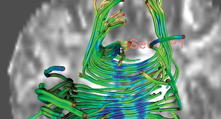 Figure 3 DTI image for brain surgery; nerve fibers are displayed (color figure available online).