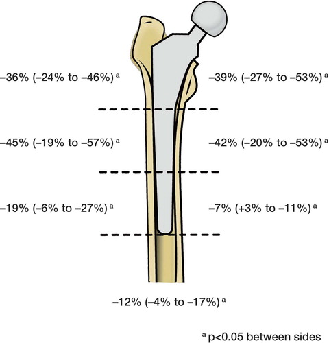 Figure 3. Percentage side difference in BMD in different Gruen regions after the rearthroplasty. Median values (25–75 percentiles) are given. An asterisk indicates a difference between sides (p < 0.05).