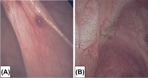 Figure 1. Peritoneal endometriosis lesions encountered at laparoscopy: (A) Red vesicular phenotype. (B) Powder burn phenotype.