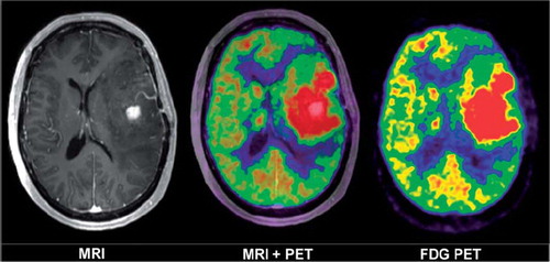 Figure 1. Transversal images through the level of the basal ganglia of a patient with glioblastoma multiforme. The T1 weighted MR after contrast injection (left image) show a central area in the left temporal lobe with contrast enhancement. The metabolic activity in temperature scale using FDG-PET (right image). The tumor region – the large red region with the highest uptake – extends far beyond the MR contrast enhanced area in all directions, as shown in the fused images (centre image).