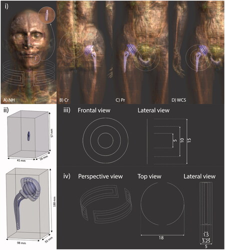 Figure 1. (i) Virtual models used for each of the considered cases, indicating the position of prostheses and coils (white hairlines): (a) head-and-neck, (b) colorectal, (c) prostate, and (d) worst-case scenario tumor locations. For (a) a 3-turn open collar-type coil has been considered, while for (b), (c) and (d) a 3-turn (inner turn of 5 cm, intermediate turn 10 cm, and outer turn of 15 cm) non-spiral, single layer, flat air coil has been used instead. For comparison purposes, prostheses are made of either Ti6Al4V or CoCrMo alloys in all the indications. (ii) Portion of voxels in the surrounding of each prosthesis that are taken into account for the scatter plot analysis. (iii) Detail of the coil used for CR, Pr and WCS tumor locations. Dimensions are presented in mm. (iv) Detail of the coil used for NH tumor location. Dimensions are presented in mm.