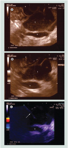 Figure 8. Ultrasound-guided fine-needle puncture. (A–C)t is seen close to a v. Fine-needle aspiration is performed through the duodenal wall. The echo of the puncture needle is seen (arrow) (C). The final diagnosis was sarcoma.t: Tumor; v: Vessel.Reproduced with permission from Citation[56].
