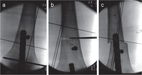 Figure 2. Intraoperative radiographs performed with the image intensifier. a. Reaming of the distal fragment according to the preoperative planning and placement of a blocking screw to allow for controlled axis correction after the osteotomy. b. Percutaneous osteotomy with a drill and osteotome. c. Angulation of the distal fragment and advancement of the straight and rigid reamers into the proximal fragment.