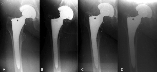 Figure 5. Distal migration of an FMT stem. A. Immediately postoperatively. B. At 3 months. C. At 12 months. D. At 24 months.