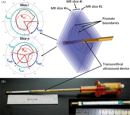 Figure 1. (a) The concept behind 3D MRI-controlled transurethral ultrasound therapy using a dual-frequency approach. During device rotation, the ultrasound frequency is switched between the fundamental frequency flow of the transducer and its 3rd harmonic fhigh ≈ 3flow. The crossover radius, Rco, determines the distance threshold for switching frequencies and was chosen to optimize treatment time and accuracy. If the prostate radius is lower than Rco, then f = fhigh, otherwise f = flow. (b) A photograph is shown of a multielement transurethral applicator consisting of 9 active elements, each measuring 5 mm long.