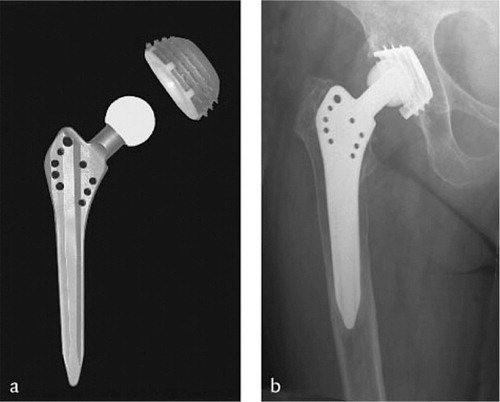Figure 2a. Cementless total hip arthroplasty with screw cup and titanium stem. 2b. Radiographic appearance.