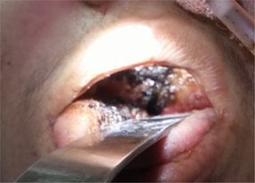 Figure 4 Black eschar with erosion of the hard palate on the right side.