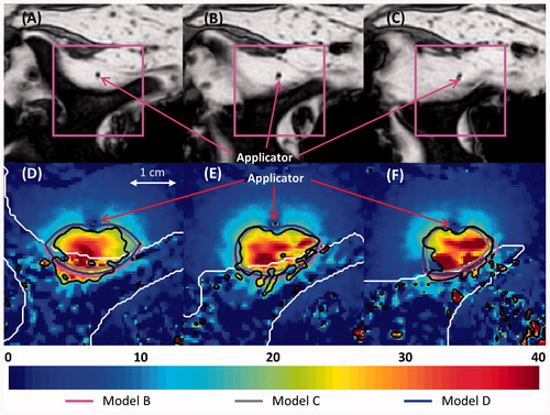 Figure 11. (A–C) MR images of the three central heated axial slices of ex vivo bovine vertebrae, spaced 5 mm apart. (D–F) Colour map of temperature increases (°C) recorded with MRTI in a smaller field of view (magenta box) for each slice 5 min into the ablation. Bone is outlined with a white line, and the 20 °C temperature increase contours recorded by MRTI are outlined in black. Also shown are the simulated 20 °C temperature increase contours produced by models B (magenta), C (grey), and D (blue).