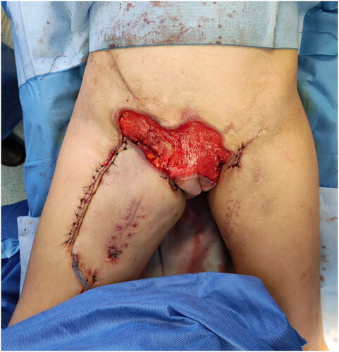 Figure 3. Appearance of the thigh after the advancement flap.