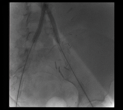 Figure 2. Deployment of EPD in the left renal transplant artery; bilateral balloon angioplasty of the terminal aorta and common iliac arteries.