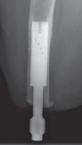 Figure 2. Implant with the addition of the transcutaneous abutment after stage-2 (S2) surgery.