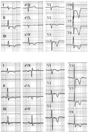 Fig. 1.  Electrocardiogram performed at the onset of chest pain (upper part) and at 5 weeks follow-up (lower part)