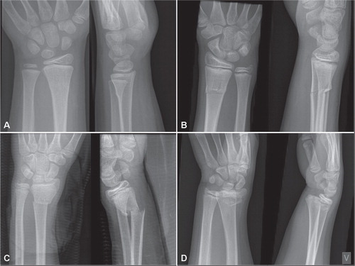 Figure 3. Examples of fractures from each category. A: Buckle fracture B: Greenstick fracture C: Complete fracture D: Physeal fracture (From Paper 3). Published by BioMedCentral Musculoskeletal Disorders.