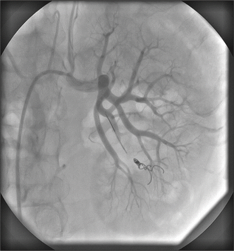 Figure 2.  Selective angiogram shows a complete exclusion of the pseudoaneurysm in left renal artery.