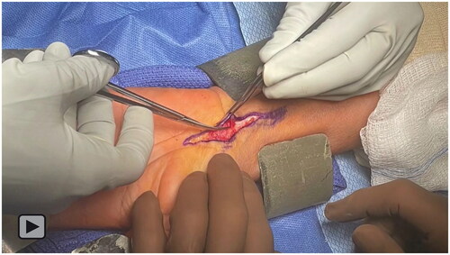 Video 1. Intraoperative video of the left wrist demonstrating an extensile approach to the carpal tunnel for decompression and collagen nerve wrapping of a fibrolipomatous hamartoma of the median nerve.
