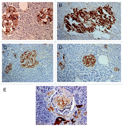 Figure 5. Control (A) and Diabetic islets, Cases 10 (B-D) and Case 14 (E) IAPP immunostaining was performed using a 1: 200 diluted antibody solution. Control islets were strongly immunostained for IAPP in the majority of islet cell cytoplasm (A). Diabetic islets of plump cytoplasm (*) were densely immunostained for IAPP in the cytoplasm, continuous to the moderately immunostained amyloid deposits (B). Diabetic islets occupying 95% amyloid deposits were immunostained moderately to strongly positive whereas viable islet cells surrounded by amyloid deposits were negative for IAPP. Two single cell islets were strongly positive for IAPP (s) (C, D). The end-stage small islets occupied by > 99% amyloid deposits revealed only a few IAPP negative residual islet cells. One strongly IAPP positive, single cell islet was localized (s) (D). Amyloid p immunostaining for the end-stage amyloid deposited islet was moderately positive in lamellar amyloid deposits and peri-islet blood vessel walls were strongly immunostained for amyloid p. Stromal amyloid deposits were moderately positive for amyloid p (E). (A) Control islet; (B-D) Case 10; (E) Case 14. (A-D) IAPP by 1: 200 diluted solution; Case 10; (E) amyloid p; Case 14 immunostained Original magnification X 350.