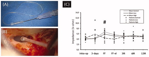 Figure 37. Insulin syringe needle pierced into the silicone reservoir (A) (Image courtesy of MED-EL). The IEC immediately after removing it from the cochlea (B) (Image courtesy of Prof. Thomas Lenarz, Hannover, Germany). Average impedance values of twelve stimulating electrode channels for the two different dosed triamcinolone compared to the control group (C). Adapted from Prenzler et al published in Frontiers in Neurology [Citation36].
