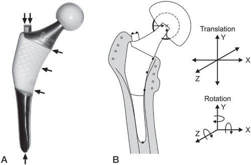 Figure 2. A. The ABG-II stem with proximal HA coating and 3 medial tantalum RSA markers (arrows). There were 2 additional RSA markers on the shoulder of the stem and 1 marker in the distal tip. B. Schematic drawing of the prosthesis with tantalum RSA markers in the prosthesis and in the surrounding bone, with the coordinate system for RSA analysis of 3D micromotion of the implant.