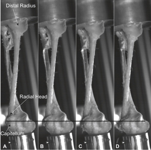 Figure 4. Part 2 of the sequence of development of an Essex-Lopresti lesion. A. The intraosseous membrane is completely ruptured. Radius moves downwards (proximal direction), leading to fracture of the radial head and increasing displacement (again in relation to the black line). B–D. The lesion progresses to a dislocation of the distal radio-ulnar joint, then to a full Essex-Lopresti lesion.