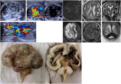 Figure 1. (A, B) Disorganised foetal intracranial structures with abnormal blood flow. Dilated superior vena cava, bilateral cephalic brachial veins and left innominate vein. (C–E, triangle) Multiple patches of high-intensity signals on T1-weighted imaging and low-intensity signals on T2-weighted imaging were distributed around the bilateral lateral ventricles just beneath the ependyma and mainly involved the left germinal matrix. (D, E, arrows) A tortuous and dilated vessel was exposed on the convex surface of the left cerebral hemisphere, and it converged into the superior sagittal sinus along with the surrounding dilated vessels. (F, triangle) The left cerebral hemisphere showed a diffuse high-intensity signal. (G, H, arrows) The bilateral transverse sinuses and sigmoid sinuses were also dilated. (I, arrows) A PAVF in a large vein on the surface of the left hemisphere. (J, arrows) Multiple haemorrhagic foci were found in the germinal matrix. In addition to diffuse encephalomalacia, atrophy of the left cerebral hemisphere and cortical dysplasia were present.