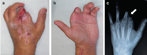 Figure 2. (a, b) Photographs showing the condition at presentation. The stumps of the fingers were almost dry with cicatricial tissue. The patient reported severe pain expanding over the region of the upper arm. (c) Preoperative radiograph showing malposition of the proximal phalanx of the index and middle fingers (arrow) caused by severe scar contracture around the two stumps.