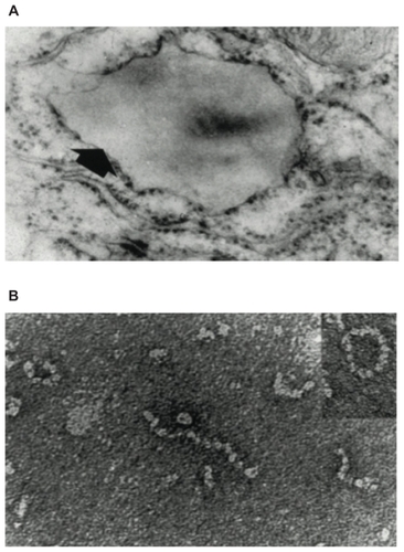 Figure 2 (A) Electron microscopy (×20,000) of a hepatocyte from a Z homozygote showing a massive inclusion (arrowed) in the endoplasmic reticulum. Reproduced from Lomas et alCitation18 with permission. (B) The intra-hepatic polymers of mutant Z α1-antitrypsin have the appearance of beads on a string on electron microscopy. Reproduced from Lomas et alCitation137 with permission.