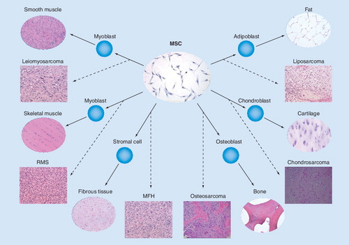 Figure 1. Mesenchymal stem cells, by virtue of their broad plasticity, may be at the origin of different histological subtypes of human sarcomas.MFH: Malignant fibrous histiocytoma; MSC: Mesenchymal stem cell; RMS: Rhabdomyosarcoma.Reproduced with permission from Citation[33].