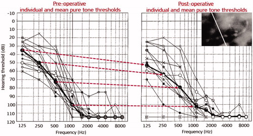 Figure 10. Individual audiograms and mean values (bold black line) with pre-op and three months post-op pure-tone thresholds in the ear chosen for implantation [Citation8]. Reproduced by permission of Taylor and Francis Group.