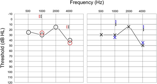 Figure 3. Face-to-face and remote audiograms obtained from one participant with mild conductive hearing loss. Black symbols indicate air conduction and masked bone conduction for traditional assessment, while red and blue symbols indicate thresholds obtained using remote testing for the right and left ear, respectively.