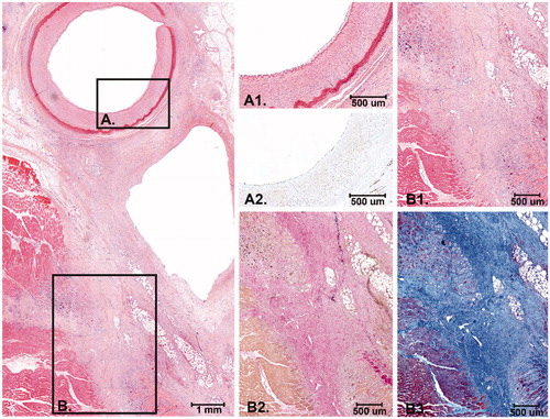 Figure 6. Histology after 14 days FUP. At the left panel an overview of the EFA, vein and the surrounding connective tissue and striated muscle is shown. The connective tissue between the artery and the vein is (partly) replaced by scar tissue with activated fibroblasts and collagen deposition. (A) Higher magnification of the intimal layer of the EFA with presence of endothelial cells and the medial layer that was largely unaffected (A1. H&E and A2: ERG immunostain). (B) The scar tissue extends into the surrounding striated muscle tissue with macrophages and remnant atrophic muscle cells (B1: H&E, B2: Elastic van Gieson stain and B3: Masson’s Trichrome stain).
