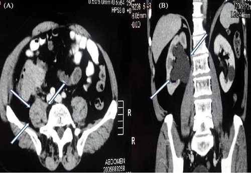 Figure 1.  (A) CT scan of the abdomen and pelvis revealed a solid lesion of dimension 7.5 × 7.5 cm from cecum to the ascending colon (white arrow). (B) CT scan showed grade 2–3 right-sided hydronephrosis (white arrow).