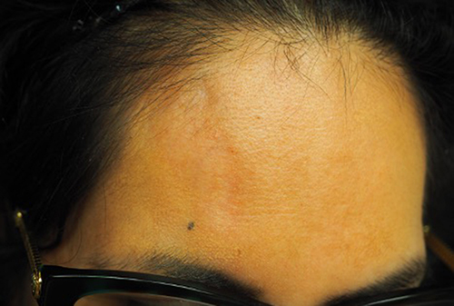 Figure 9 En coup de sabre is a subtype of linear morphea presenting as a hyper to hypopigmented indurated plaque extending linearly down the paramedian or temporal forehead.