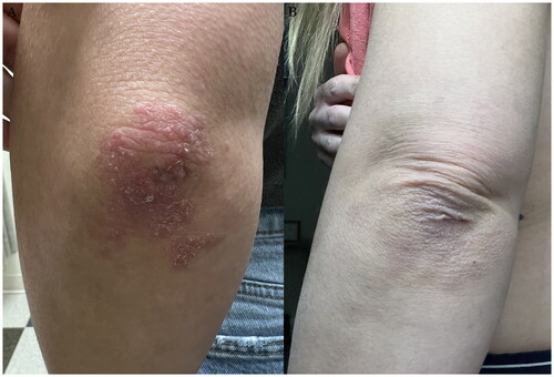Figure 2. (A,B) Before (week 0) and after (week 12) photographs of psoriasis of the left elbow.