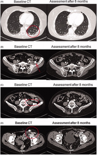 Figure 2. Baseline and eight months CT scans demonstrating complete response for a patient with low-grade serous ovarian cancer treated with combination of BRAF and MEK inhibitors. (A) Lung metastases. (B, C) Lymph node metastases at left pelvic wall. (D) Lymph node metastases in left groin.