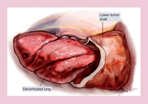 Figure 5. Pleurectomy/decortication: the fully decorticated lung is retracted out of the lower tumor shell.The tumor shell is then resected and removed from the operative field.Reprinted with permission from Citation[70].