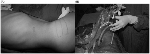 Figure 2. (A) The contralateral prone position and incision site. (B) PCNL surgery.