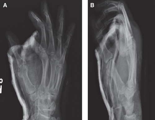 Figure 2. Anteroposterior (A) and lateral (B) view radiographs at two-week follow up demonstrate maintenance of reduction and congruent thumb metacarpophalangeal joint. At this time, the splint was removed and patient was allowed to begin range-of-motion activities.