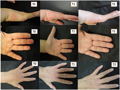 Figure 3. Three patients treated with Rilastil Difesa sterile®. improvement of erythema and scaling during the two months of treatment.