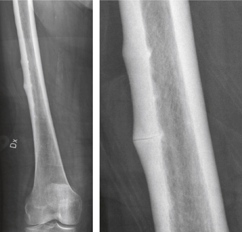 Figure 2. Right femur. Multifocal atypical fractures while using denosumab 2014 (overview and magnification). Note the visible crack.