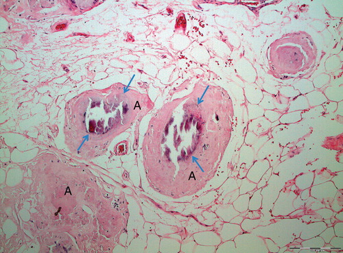 Figure 1. Localized AL amyloidosis in a breast. The localized nature and occurrence of microcalcifications (arrows) constitute a risk of misdiagnosis of mammary carcinoma.
