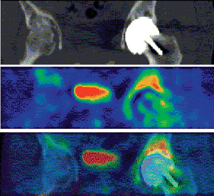 Figure 2. Scans with normal viable bone 4 months after surgery. Top panel: CT; middle panel: PET; bottom panel: combined PET-CT.