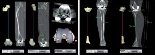 Figure 1. Preoperative planning software (Materialise NV) and postoperative CT measurements for frontal femoral component angle (FFCA), sagittal femoral component angle (SFCA), axial femoral component angle (AFCA), frontal tibial component angle (FTCA), and sagittal tibial component angle (STCA).