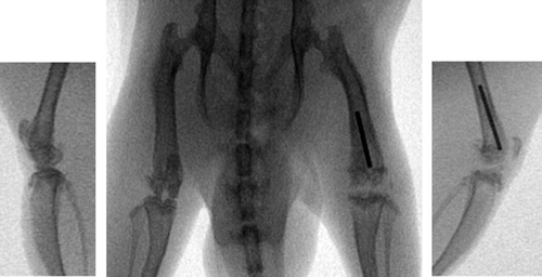 Figure 2. Radiographical appearance of osteomyelitis. Left femur with implanted needle. Signs of osteomyelitis of the distal femur, arthritis of the knee, and osteomyelitis of the proximal tibia are apparent in the left leg.