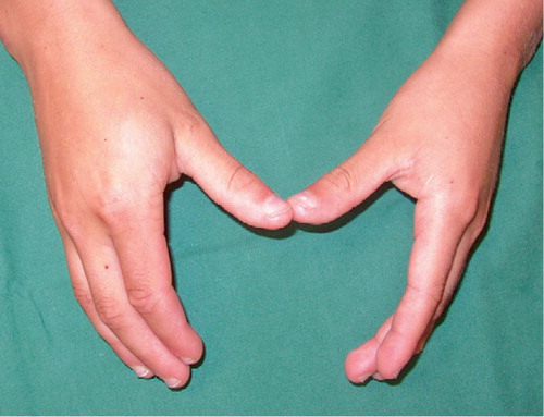 Figure 1. Swelling of the first dorsal web space of the right hand.