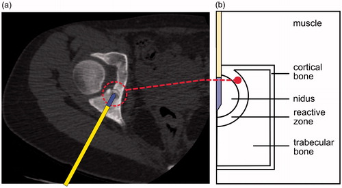 Figure 1. (a) Cortical osteoid osteoma consisting of a nidus surrounded by cortical and trabecular bone. The RF applicator is introduced into the nidus through a drill hole prior to RF application. (b) Theoretical model of cortical OO consisting of a nidus enclosed by a reactive zone.