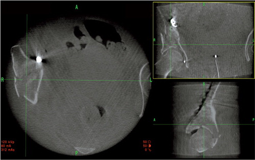 Figure 4. Intraoperative 2D reconstructed views of the unreduced fragment in the supra-acetabular region of a 2-column fracture. Axial view to the left, coronal view to the upper right, and sagittal view to the lower right. The fracture can be reduced with a ball spike through a stab incision laterally and the screw paths for the screws that indirectly fixate the fracture can be planned. The result achieved is shown in Figure 5.