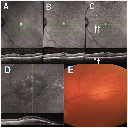 FIGURE 1. Infrared, optical coherence tomography and color images of an 82-year-old patient diagnosed with primary vitreoretinal lymphoma. (A–C) Drusenoid deposits are visible on infrared imaging that evolved over the course of 6 months and prior to the diagnosis of lymphoma. (D) A vertical line scan through the whitish sub-RPE deposit seen in color photograph (E).