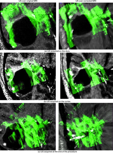 Figure 9. Tumor case. The ultrasound images acquired at various stages in the procedure are displayed in green overlaid onto the original MRI (left column) and onto the corrected MRI (right column). The images were acquired as follows: (a) on the dura surface; (b) on the cortex after the opening of the dura; and (c) at the end of the procedure. These transverse images depict the tumor in black. Notice that the corrected MRIs (on the right) depict more closely the surgical reality as reflected by the US images than do the original MRIs. This is particularly evident at the end of the procedure when the tumor has been resected, and was no longer visible in the US image. The final corrected MRI accurately reflects the absence of the tumor.