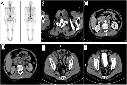 Figure 2. Partial imaging examinations after the patient developed metastatic symptoms. (A) whole-body bone tomography showed active bone salt metabolism in lumbar 1–4 vertebrae, mostly considering bone metastases; (B) chest CT showed multiple enlarged lymph nodes in the left side of the neck, considering possible metastases; (C,D) whole-abdomen CT showed multiple retroperitoneal lymph node metastases; (E,F) whole-services CT showed multiple pelvic lymph node metastases.