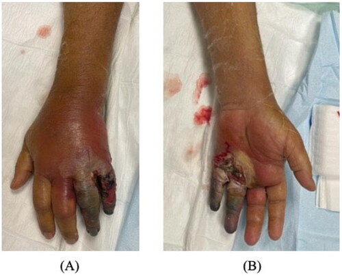 Figure 1. Wet gangrene of the little and ring fingers on initial presentation, with diffuse swelling reaching the palm. (A) Dorsal. (B) Volar.